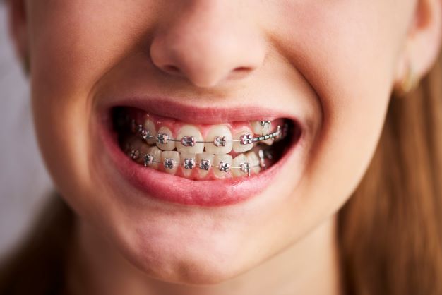 shot-teeth-with-braces-In-attapur